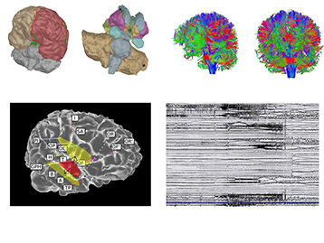 Le Patient Epileptique Virtuel