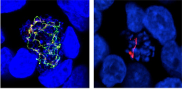 Parasite de la malaria à l'intérieur de cellules de foie humaines. 