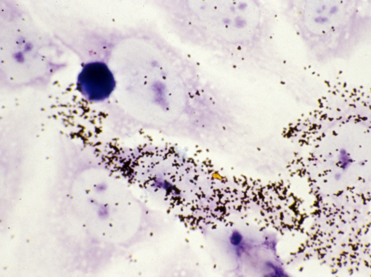 Hybridation in situ des ARN du virus du sida (VIH) dans les cellules immunitaires infectées (HeLa CD4+)