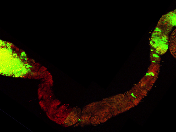 tumeurs dans le tube digestif d'une drosophile