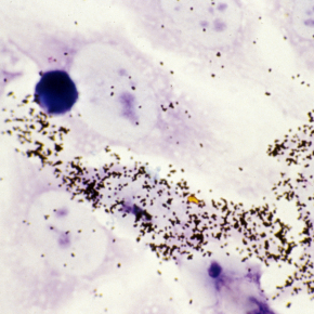 Hybridation in situ des ARN du virus du sida (VIH) dans les cellules immunitaires infectées (HeLa CD4+)