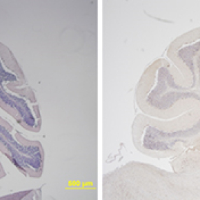 In the eye of the medulloblastoma